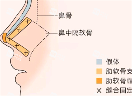 隆鼻形态.png
