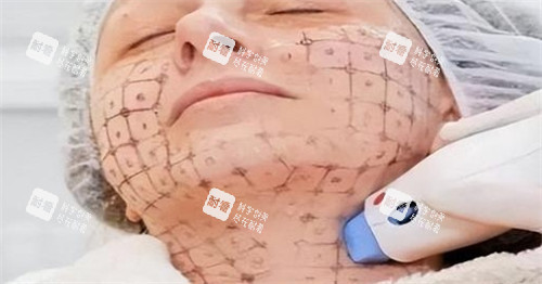热玛吉中下面部设计点位图.jpg