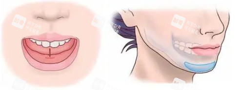 假体垫下巴的位置.jpg