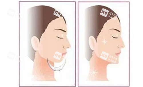 假体垫下巴.jpg