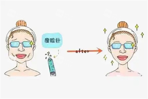 韩国威德诊所济州岛店肉毒能维持多久？个体差异大，面诊时问清复诊周期才稳妥