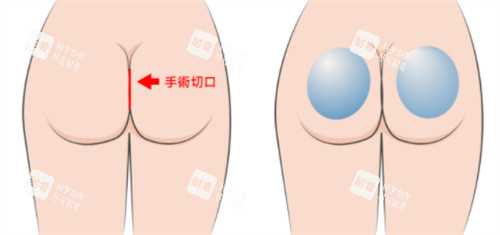 假体丰臀手术切口.jpg 假体丰臀手术切口.jpg