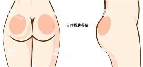自体脂肪丰臀.jpg 自体脂肪丰臀.jpg
