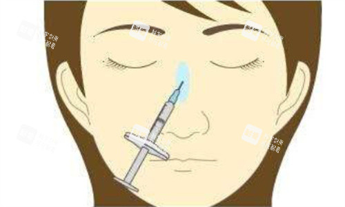 注射隆鼻正面.jpg