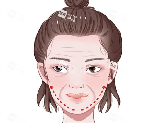 面部抗衰提升卡通图.jpg