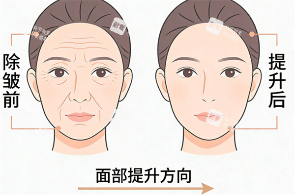 面部提升除皱前后对比.jpg