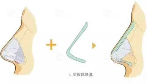 L型假体隆鼻步骤示意图.jpg
