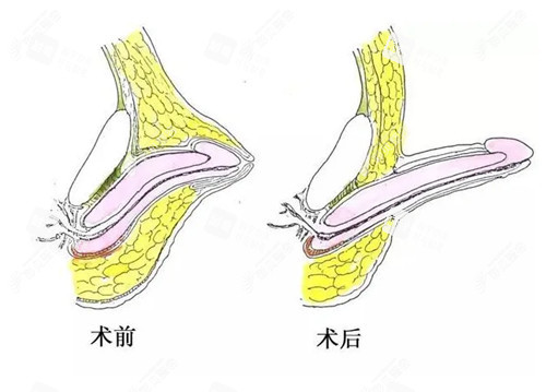 男性私密整形阴茎增长手术示意图.jpg 男性私密整形阴茎增长手术示意图.jpg