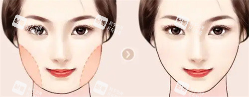 面部吸脂.jpg 面部吸脂.jpg