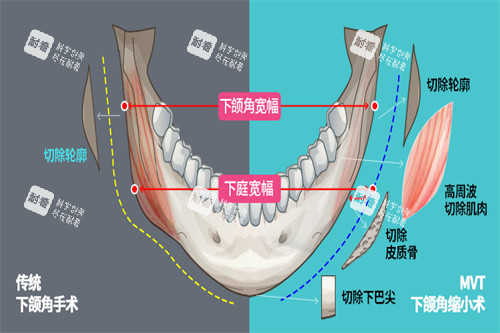 下颌角手术宣传图.jpg