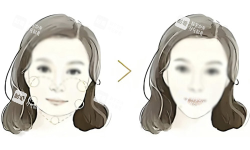 面部吸脂对比.jpg