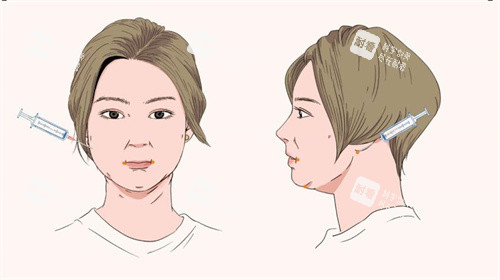 面部吸脂手术针管注射点位动画图.jpg