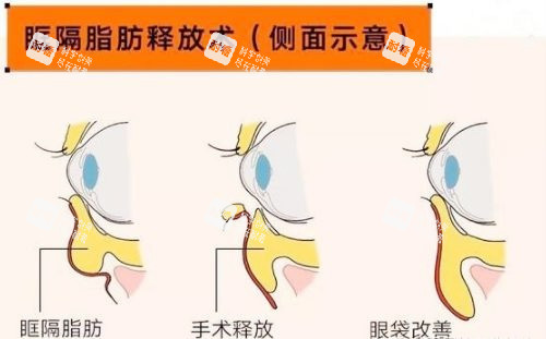 眶隔脂肪祛眼袋.jpg