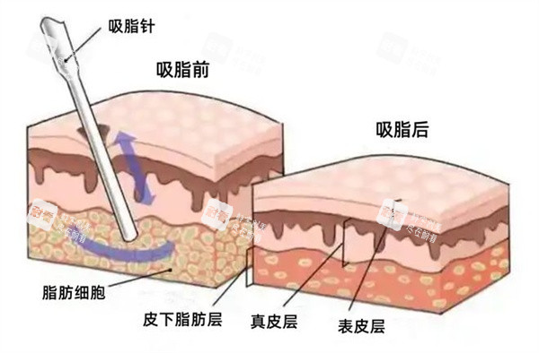 面部吸脂图.jpg