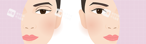 双眼皮失败修复.png