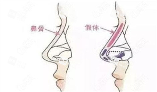 隆鼻手术示意图.jpg 隆鼻手术示意图.jpg