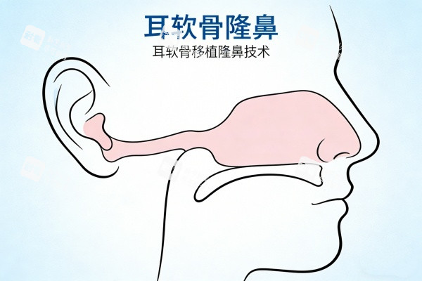 耳软骨隆鼻卡通图一览.jpg 耳软骨隆鼻卡通图一览.jpg