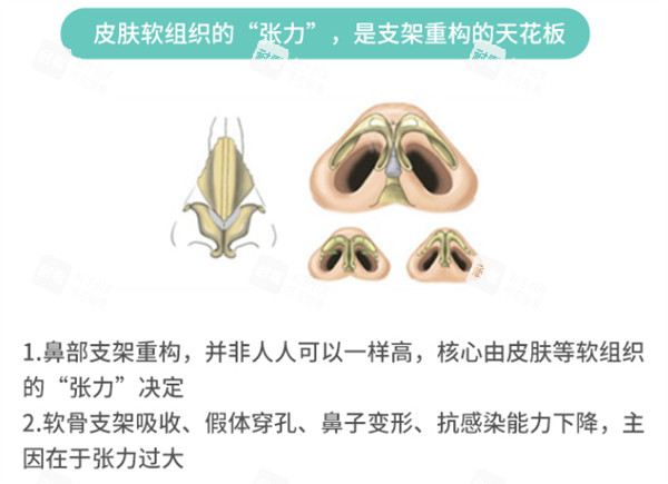 隆鼻方案怎么选.jpg