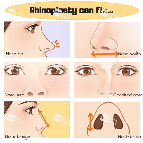 鼻修复流程一览图.jpg 鼻修复流程一览图.jpg