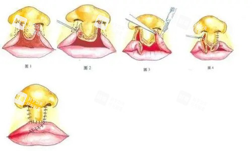 唇裂鼻修复图.jpg 唇裂鼻修复图.jpg