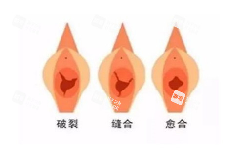 私密整形治疗图片展示.jpg 私密整形治疗图片展示.jpg