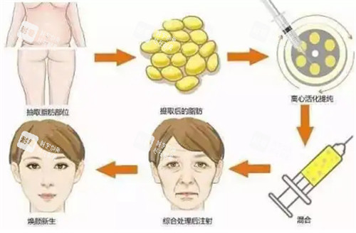 自体脂肪填充过程图解.jpg