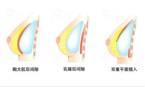隆胸假体植入方式示意.jpg