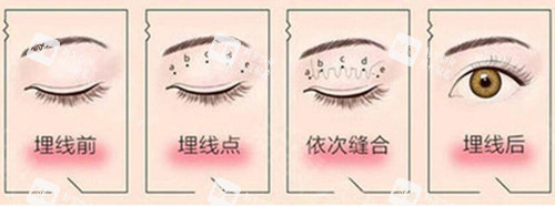 埋线双眼皮过程示意图片.jpg