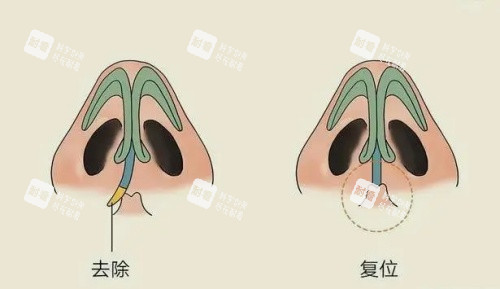 歪鼻修复矫正.jpg
