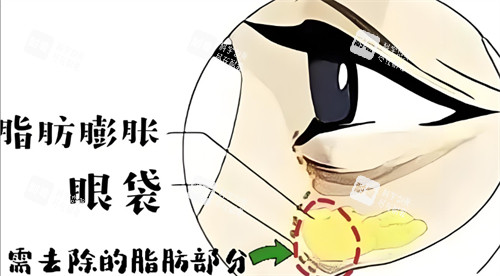 脂肪膨胀性眼袋需要去除的部分.jpg 脂肪膨胀性眼袋需要去除的部分.jpg