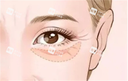 眼袋形成的衰老.jpg 眼袋形成的衰老.jpg