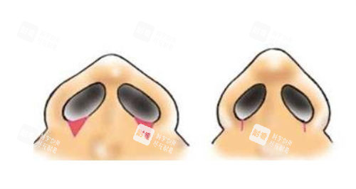 鼻小柱矫正前后对比示意图.jpg 鼻小柱矫正前后对比示意图.jpg