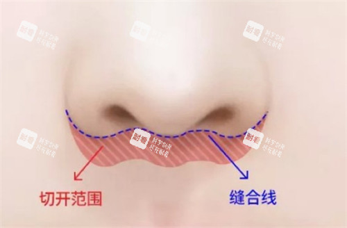 埋线人中缩短术手术位置图解.jpg