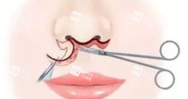 埋线人中缩短术手术过程图解.png