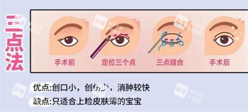 双眼皮手术三点法动画演示图.jpg 双眼皮手术三点法动画演示图.jpg
