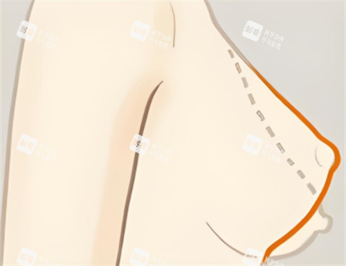 乳房下垂矫正轮廓对比.jpg 乳房下垂矫正轮廓对比.jpg