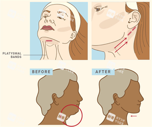 面部提升改善下颌.jpg