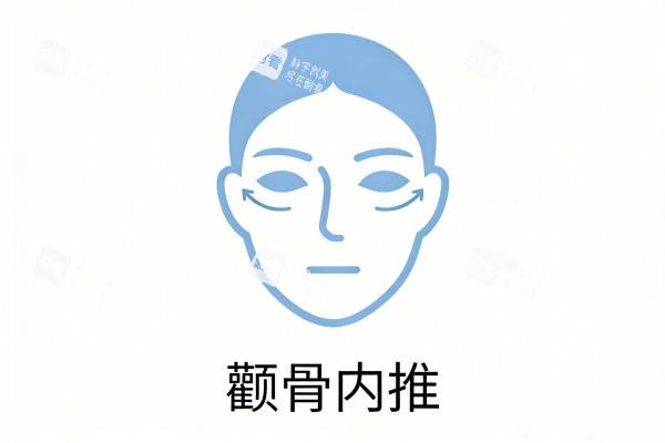 颧骨内推图片展示.jpg