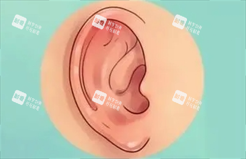耳轮廓耳畸形动画展示.png 耳轮廓耳畸形动画展示.png