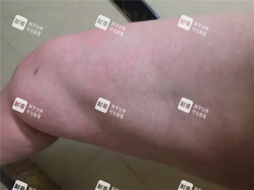 吸脂凹凸不平图示.jpg 吸脂凹凸不平图示.jpg
