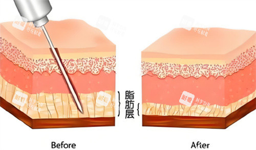吸脂手术脂肪层对比.jpg