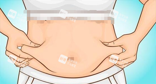 吸脂手术腹部脂肪堆积.png