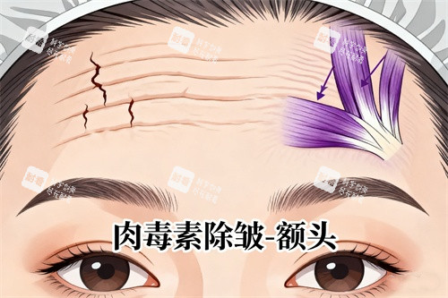 抬头纹注射卡通图.jpg