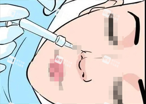 玻尿酸注射鼻子动画展示.png