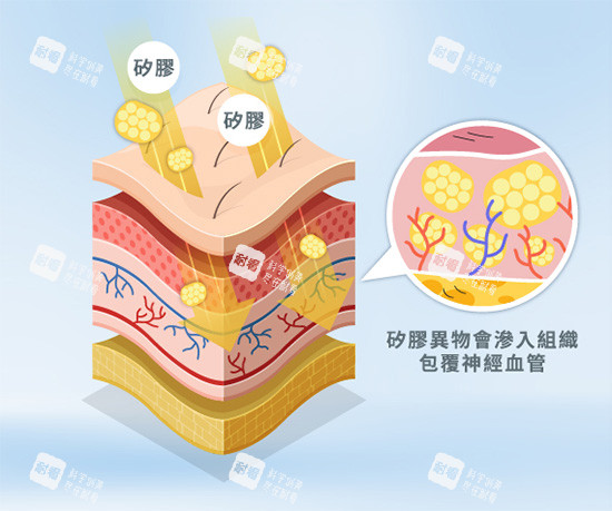 馒化针注射示意图.jpg
