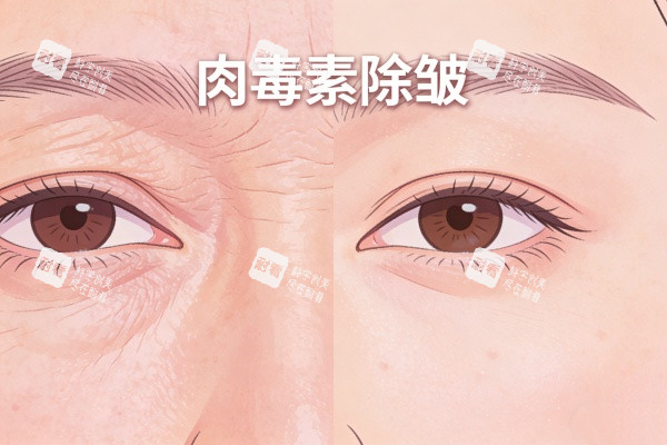 注射针剂除皱前后对比图.jpg