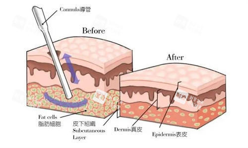吸脂手术.jpg