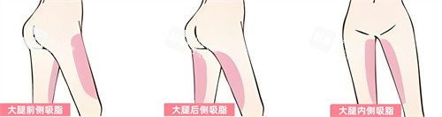 腿部吸脂部位展示动画图.jpg