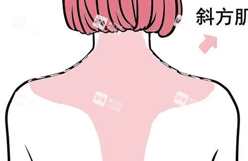 背部吸脂卡通示意图.jpg