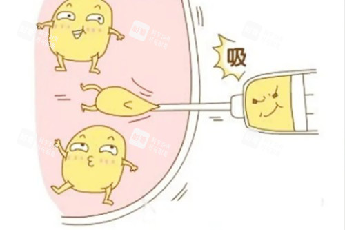 吸脂卡通展示图.jpg 吸脂卡通展示图.jpg